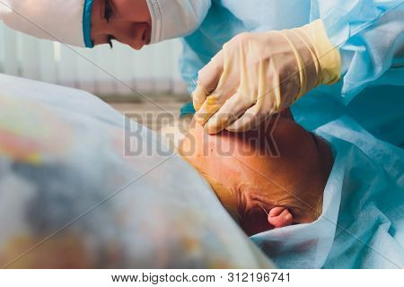 Aged Woman Doing Mesothreads And Thread Lifting, Cosmetology. Cosmetic Procedure To Eliminate Signs 