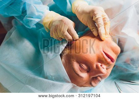 Aged Woman Doing Mesothreads And Thread Lifting, Cosmetology. Cosmetic Procedure To Eliminate Signs 