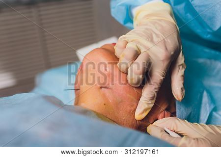 Aged Woman Doing Mesothreads And Thread Lifting, Cosmetology. Cosmetic Procedure To Eliminate Signs 