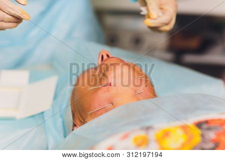 Aged Woman Doing Mesothreads And Thread Lifting, Cosmetology. Cosmetic Procedure To Eliminate Signs 