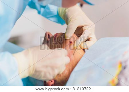 Aged Woman Doing Mesothreads And Thread Lifting, Cosmetology. Cosmetic Procedure To Eliminate Signs 