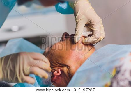 Aged Woman Doing Mesothreads And Thread Lifting, Cosmetology. Cosmetic Procedure To Eliminate Signs 