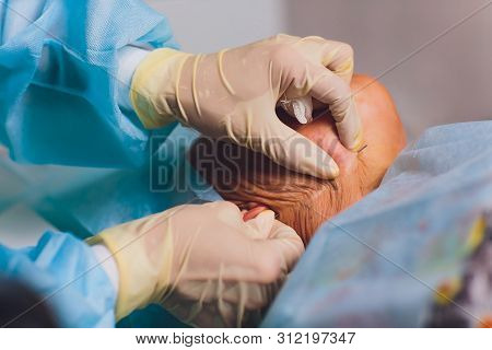 Aged Woman Doing Mesothreads And Thread Lifting, Cosmetology. Cosmetic Procedure To Eliminate Signs 