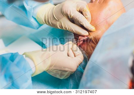 Aged Woman Doing Mesothreads And Thread Lifting, Cosmetology. Cosmetic Procedure To Eliminate Signs 