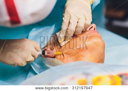 Aged Woman Doing Mesothreads And Thread Lifting, Cosmetology. Cosmetic Procedure To Eliminate Signs 