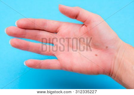 Open Female Palm With Two Moles On A Blue Background