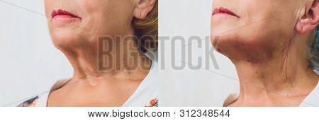 Aged Woman Doing Mesothreads And Thread Lifting, Cosmetology. Cosmetic Procedure To Eliminate Signs 