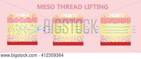 Meso Thread Lift. Young And Old Skin. Lifting By Threads Concept. Vector Illustration