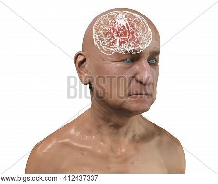 Dementia, Conceptual 3d Illustration Showing An Elderly Person With Progressive Impairments Of Brain