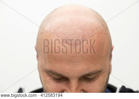 man after hair implant therapy