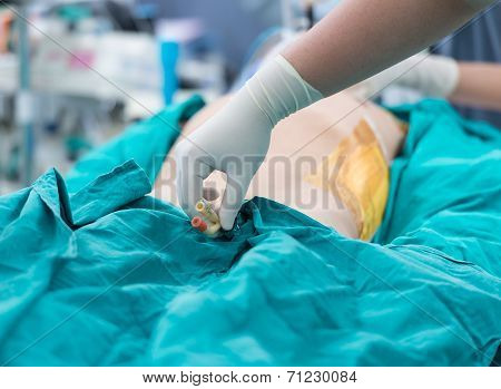 Retain Foley Catheter