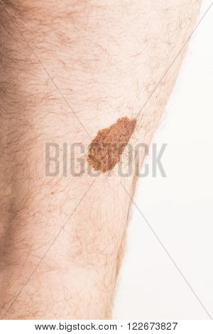 Melanoma angioma beauty mark spot on man skin France