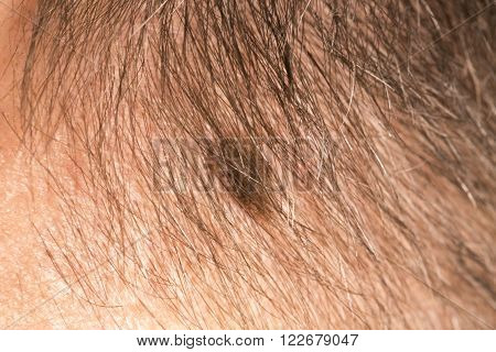 Melanoma angioma beauty mark spot on man head face France