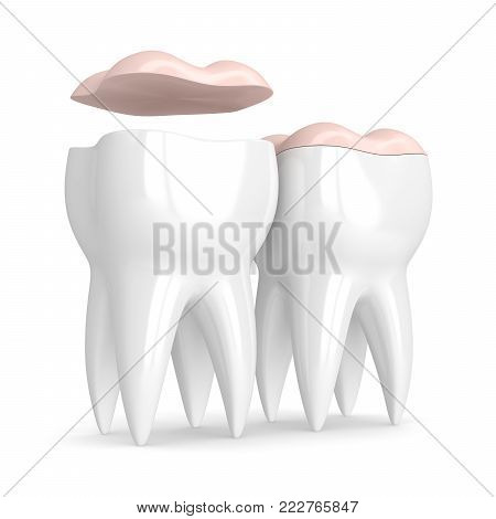 3D Render Of Teeth With Dental Onlay