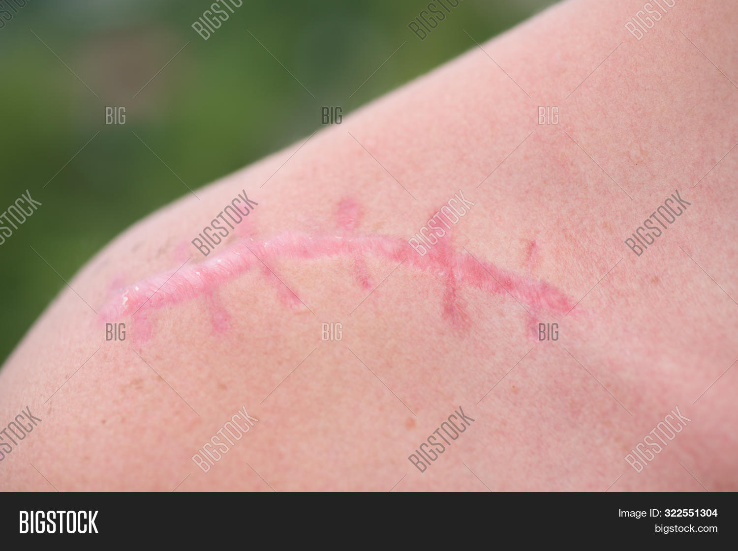 Scar. Skin Wound. Image & Photo (Free Trial) Bigstock