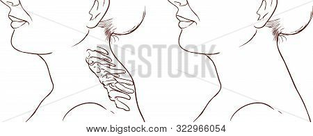 Woman Symptom Buffalo Hump Illustration Vector Illustration