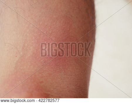 A Bruise That Has Been Stung By An Insect.
