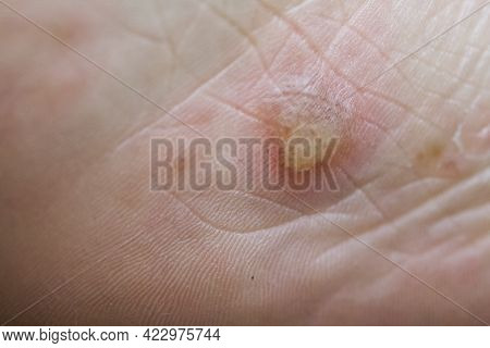 Dyshidrotic Eczema On The Foot, Dermatitis. Nearby Is A Bandage And A Plaster For Processing. Close-