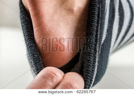 Man With A Blister On His Heel