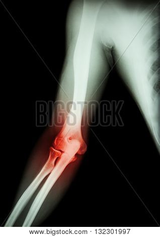 Arthritis at elbow . film x-ray of arm elbow forearm and inflammation at elbow ( Gouty arthritis , Rheumatoid arthritis ) ( black background )