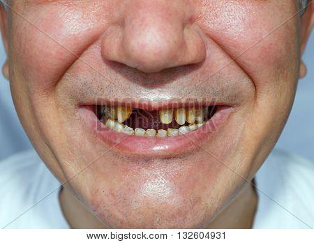 a man without two teeth and peeled the upper teeth for bridge installation