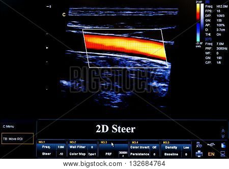 Colourful Ultrasound Monitor Image. 2D Steer