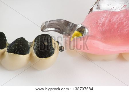 Clasp Prosthesis With And Latch Ceramic Crowns