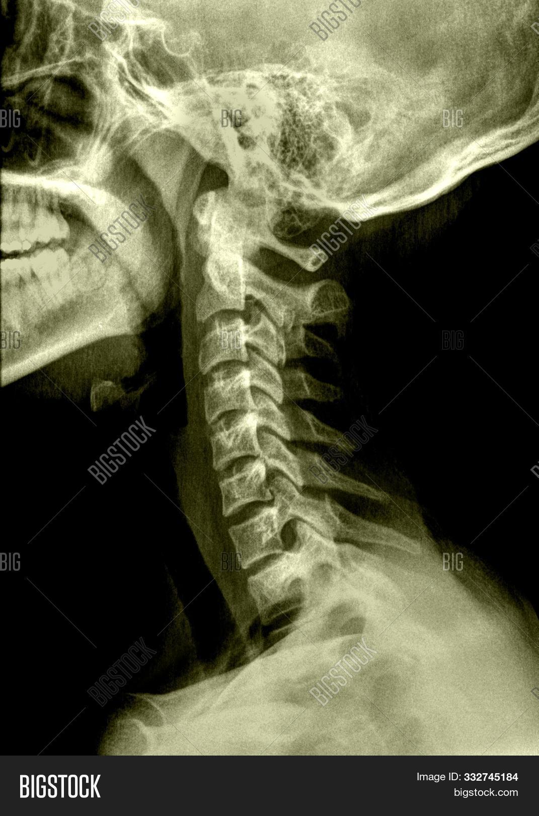 radiografía lateral de anatomía del cuello