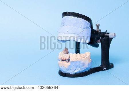 Tooth Recovery With Implant. Plaster Model Of Teeth. Upper And Lower Jaws Plaster Model With Prepare