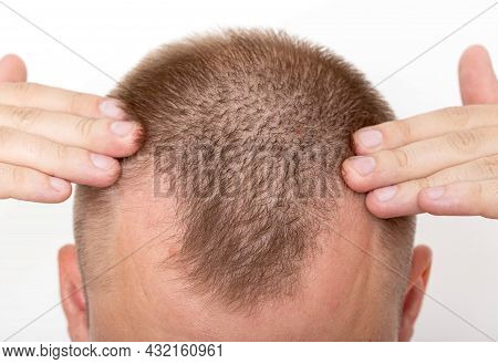 Bald Patches On The Head Of A Young Man. The Concept Of The Increased Hormone Dihydrotestosterone. W