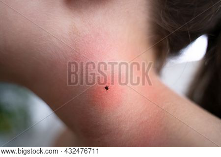 Encephalitis Mite Bug Or Arachnid Parasite Under Child Skin