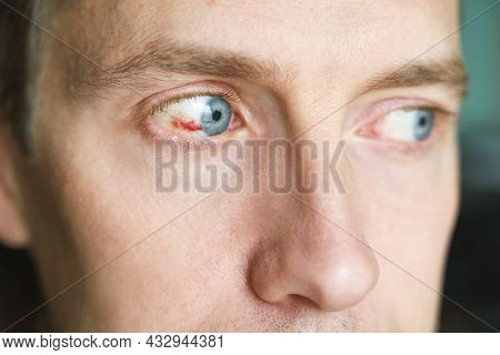 Man Damaged Eye Ball. Conjunctivitis Blood. Allergy Ophtalmology Test. Medical Redness Concept. Asti