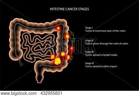 Colorectal Cancer Concept. Development Of Cancer From The Colon Or Rectum To The Whole Large Intesti