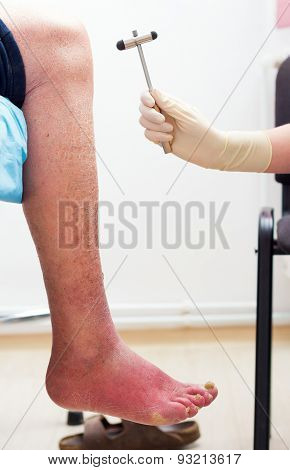 Knee Reflex