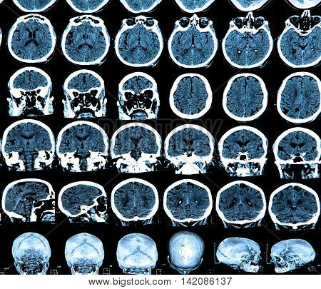 MRI scan of the human brain - medical concepts