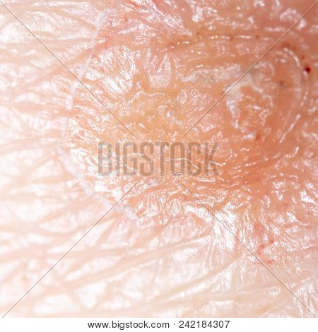 Ringworm On The Human Skin As A Background. Macro