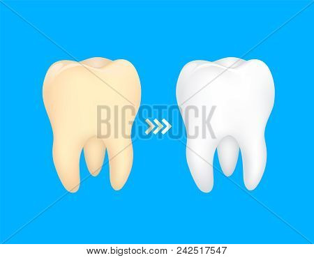 Tooth Before And After. Yellow Becomes White, Dental Care Concept,  Illustration Isolated On Blue Ba