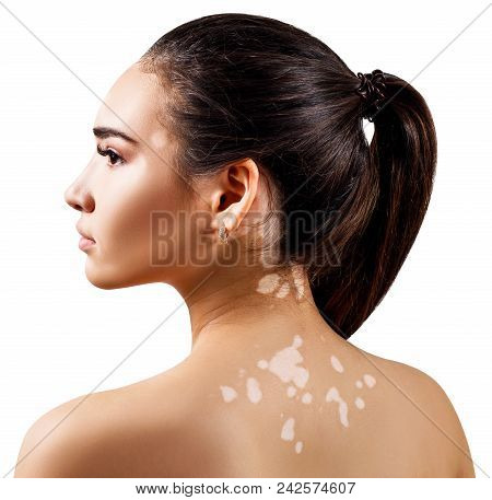 Profile Portrait Of Beautiful Woman With Vitiligo. Isolated On White Background.