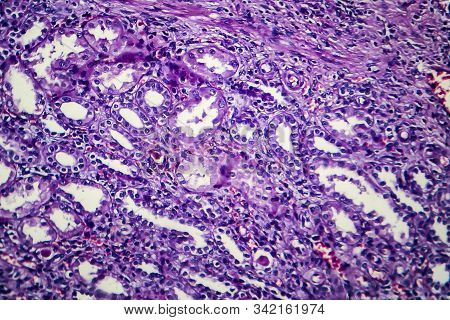 Chronic Nephritis, Light Micrograph, Photo Under Microscope