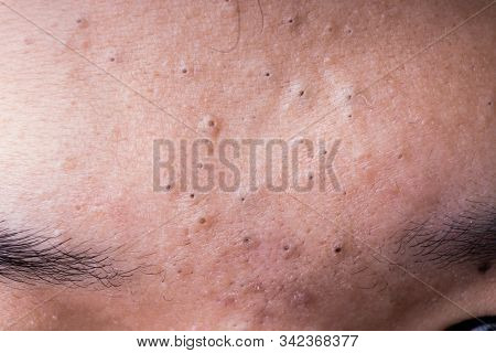 Ugly Pimples Blackheads On Forehead Of Teenager