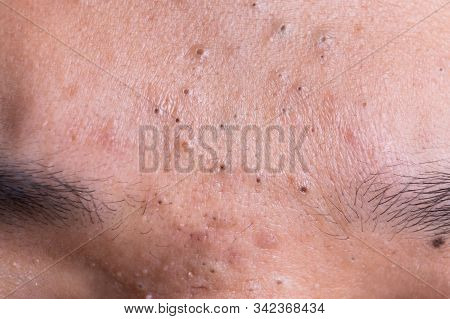 Ugly Pimples Blackheads On Forehead Of Teenager