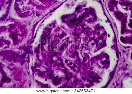 Diffuse Proliferative Glomerulonephritis, Dpgn, Light Micrograph, Photo Under Microscope. High Magni