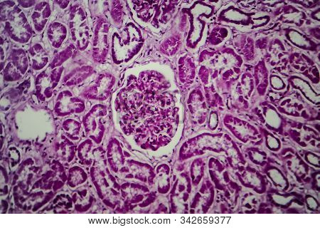 Histopathology Of Diffuse Sclerosing Glomerulonephritis, Light Micrograph, Photo Under Microscope