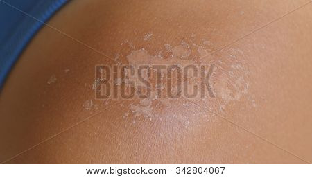 Sunburned skin, peeling skin from a sunburn