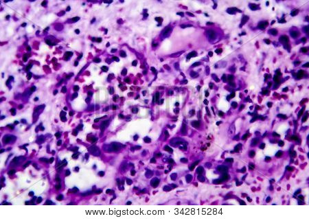 Histopathology Of Interstitial Nephritis, Light Micrograph, Photo Under Microscope. High Magnificati