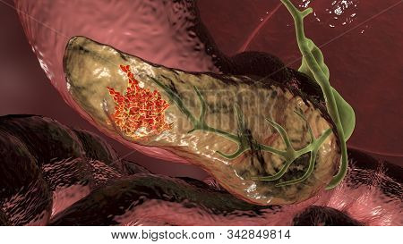 Pancreatic Cancer, Malignant Tumor Of Pancreas, 3d Illustration