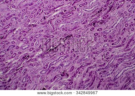 Diffuse Proliferative Glomerulonephritis, Dpgn, Light Micrograph, Photo Under Microscope