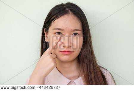 Asian Woman Pointing Hard Pimple (or Elephant Head Acne) With Acne Inflamed On Her Face. Hard Pimple