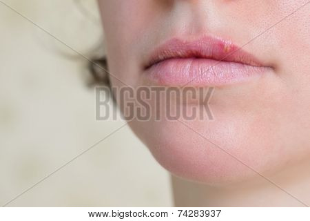 Herpes Virus On Female Lips
