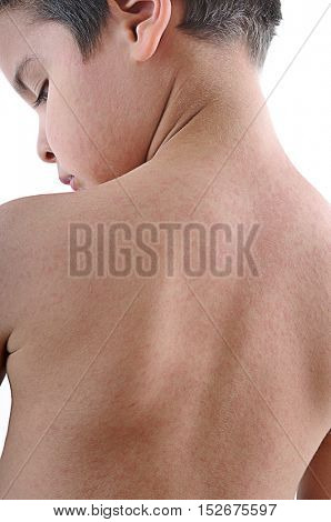 Back of little boy affected by urticaria isolated on white background.